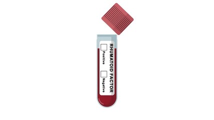 Animated rheumatoid factor test tube showing a positive result with a red check mark. RF test for arthritis or autoimmune disease diagnosing concept in a medical laboratory.