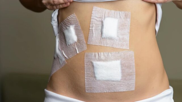 Young woman's belly after surgical operation by laparoscopy in hospital, concept of gallbladder, myoma