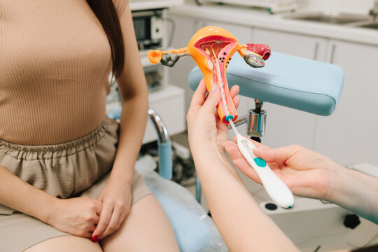 Gynecologist demonstrates intrauterine device IUD insertion using uterus model. Gynecologist demonstrates contraceptive IUD insertion through cervical canal. Process of IUD placement on uterus model.