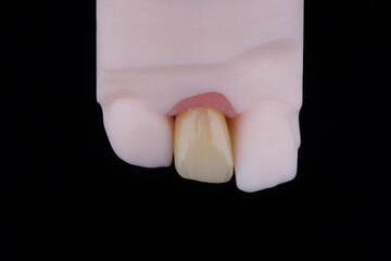 Mirror copy of lateral maxillary incisor, zirconia crown on titanium abutment fixed on printed model