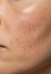 Cluster of Sun Spots on Cheekbone Before Laser