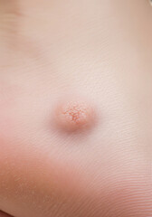Fototapeta premium Plantar Wart (Verruca) on the Sole of the Foot