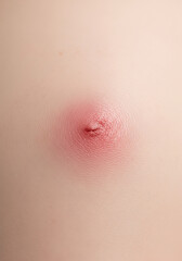Fototapeta premium Strawberry Nevus (Infantile Hemangioma) on Infant Skin
