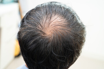 Bald in the middle head and begin no loss hair glabrous of mature Asian business smart active...