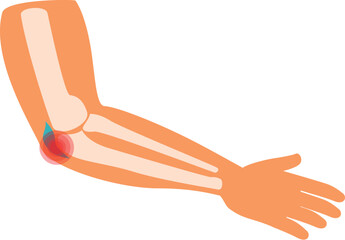 Human arm with elbow pain, showing bones and joint inflammation