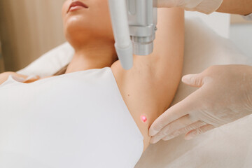 Laser Mole Removal close-up. Non-invasive laser mole therapy eliminates blemishes safely. Laser...