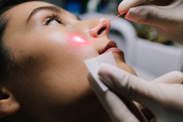 Aesthetic laser removal of nevi and benign growths. Dermatologist performs precise laser removal of a facial nevus and other benign lesions. Laser dermatologic treatment for nevus and mole removal.