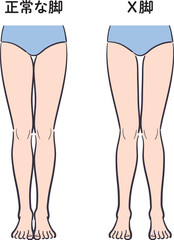 正常な脚とX脚のセット