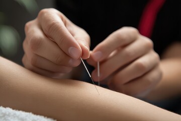 Acupuncture Arm. Closeup of Young Woman Undergoing Acupuncture Treatment by Acupuncturist