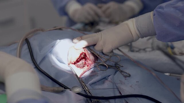 Tympanoplasty, the surgeon sutures the incision in the ear fold after a successful surgical intervention