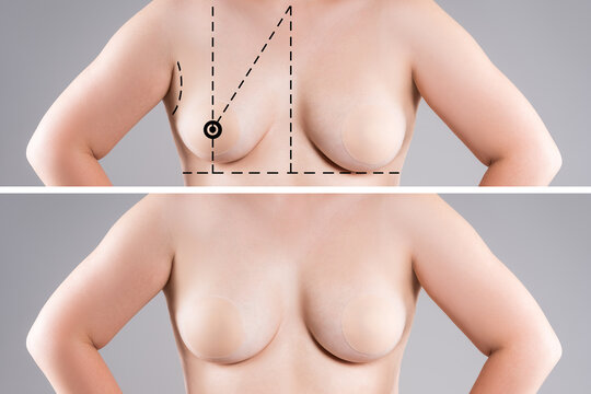 Before and after breast augmentation, woman with asymmetric saggy breasts, reduction mammoplasty, aesthetic plastic surgery, healthcare and medicine concept