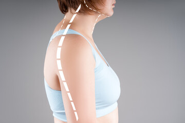 Poor posture, neck pain, cervical spine hernia and osteochondrosis, woman with curvature of spine...