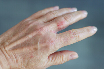 woman hand with scratched finger, wound