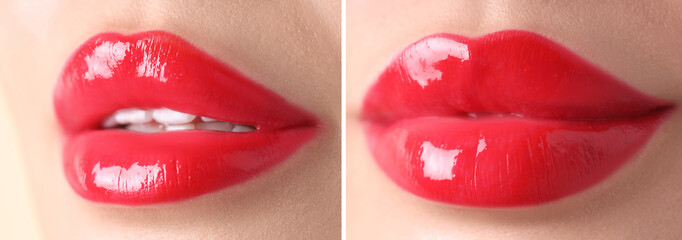 Lip augmentation, collage. Woman showing her lips before and after cosmetic procedure, closeup