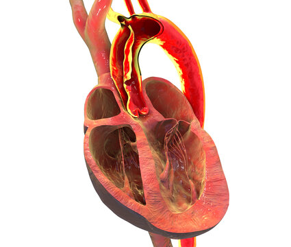 Ascending aortic dissection, 3D illustration