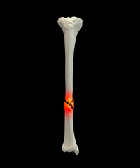 Tibia shaft fracture, 3D illustration. Shows a break in the tibial shaft, commonly caused by trauma. Clinically important for orthopedic assessment, surgical fixation, and fracture classification.