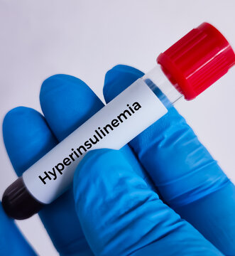 Blood sample for hyperinsulinemia test used to detect insulin resistance. OGTT. Glucose Challenge test.