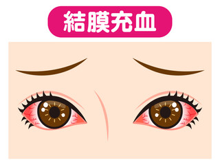 	結膜充血で充血した両目のイラスト素材