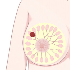 Blank Breast cancer Stage 2 diagram Human anatomy PNG