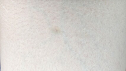 Small bruises on the human body.