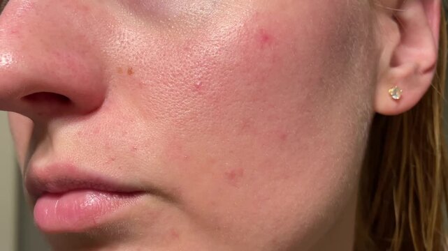 Macro view of natural facial skin with visible pores and redness in soft daylight. Ideal for skincare, dermatology, beauty, cosmetic, and health-related visuals.