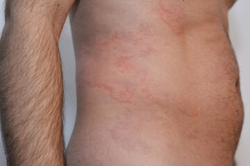 Skin rashes on a man's body due to a severe allergy.