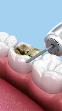 Dental onlay ceramic crown restoration. Animation of human teeth treatment