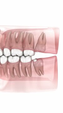 Wisdom tooth and gum inflammation. 3D animation