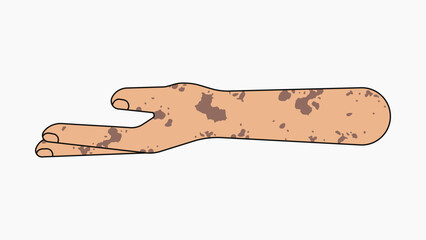 Vitiligo helping hand gesture, flat collage element vector