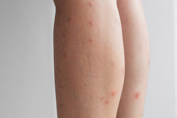 Close-up of a person s leg skin with multiple red spots and irritation, concept of dermatology,...
