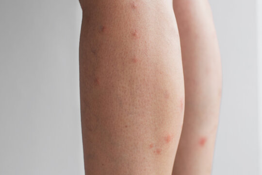 Close-up of a person s leg skin with multiple red spots and irritation, concept of dermatology, allergy, skin care and health problem awareness
