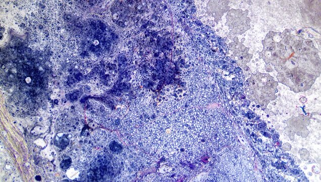 Microscopic View of Pulmonary Fungal Infection with Hematoxylin and Eosin Staining