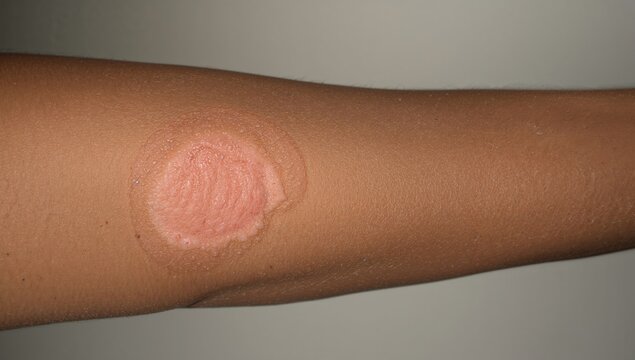 Vaccination against smallpox triggers eczema skin reaction