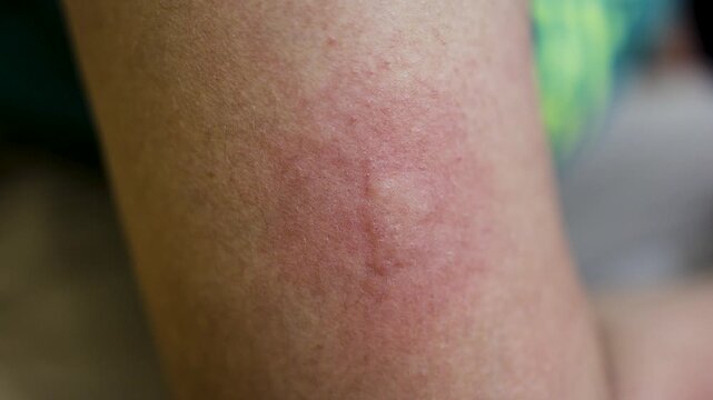 skin allergy showing severe irritation and redness from bug bite or insect sting
