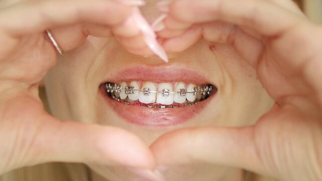A young woman smiling with metal dental braces on teeth and showing love heart shape with her hands. Concept of orthodontics, dental care, oral hygiene, and healthy smile.