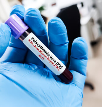 Blood sample for Polycythemia Vera (PV) test. CBC, JAK2,EPO, Bone marrow biopsy test.