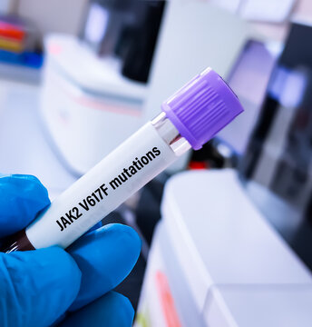 Blood sample for JAK2 V617F mutation test, It7 is a specific mutation in the JAK2 gene commonly associated with polycythemia vera, a type of myeloproliferative disorder