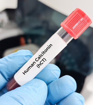 Blood sample for calcitonin hormone test,It acts to reduce blood calcium, opposing the effects of parathyroid hormone (PTH) to diagnosis of Medullary thyroid cancer (MTC) and C-cell hyperplasia.