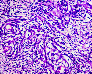 Schwannoma, Spinal schwannomas are benign nerve sheath tumors within the spinal canal, typically arising from spinal nerve roots and it is the most common nerve sheath tumor of spine. Nerve tumors.