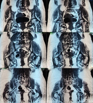 MRI of pelvis, suggestive of Chronic avascular necrosis of both femoral head with possible involvement of the neck,associated with Chronic osteoarthritis