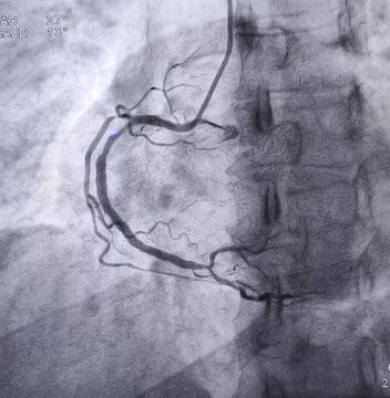 Coronary angiogram of right coronary artery during cardiac catheterization with dye. Findings abnormal