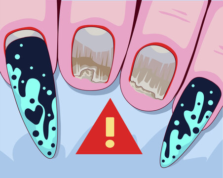 Nail plate disease. Nail plate fungus. Healthcare illustration.Vector illustration.