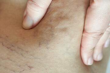 Naklejka premium Close-up of stretch marks and hands on skin.