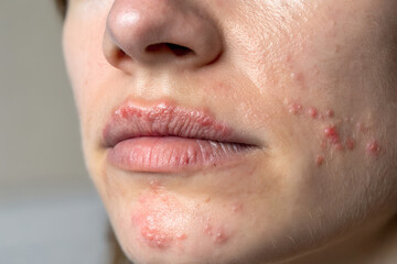 Fototapeta premium herpes simplex virus on the lip, cold sore with redness and blisters