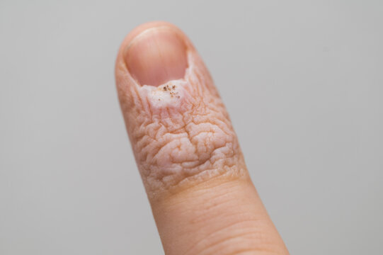 Macro close up of dry cracked skin and fungal infection on human thumb finger nail
