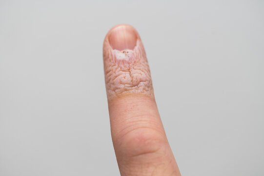 Macro close up of dry cracked skin and fungal infection on human thumb finger nail