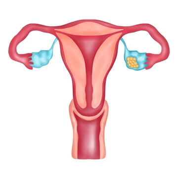 Ovarian Cancer, Hand-drawn Watercolor Illustration