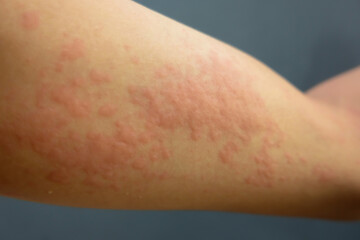 Fototapeta premium Close-Up of Human Hand with Skin Allergy (Urticaria Rash)