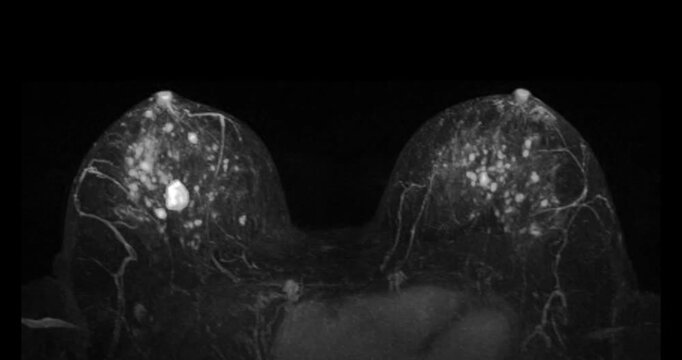 MRI of the breast footage demonstrating a round hypoechoic lesion in the right breast. Advanced radiology imaging for tumor detection and diagnostic evaluation. Low suspicion for malignancy.