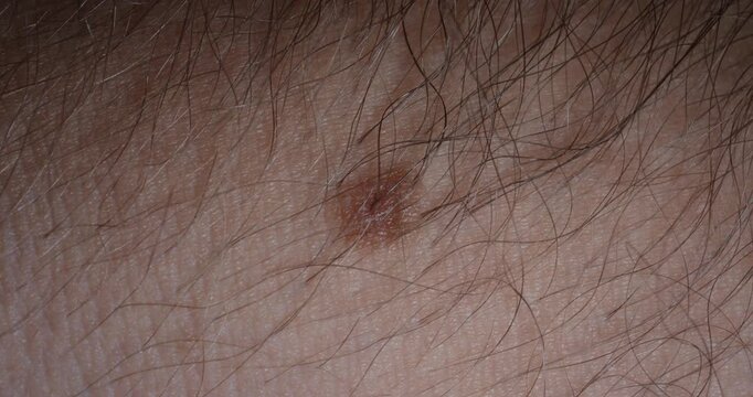 Close-up of a mole with hair on human skin. Concept: skin health, melanoma risk, dermatology, prevention, sunscreen awareness, medical education, early detection, aging.